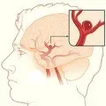 creier tratament hidrocefalie, simptome si cauze (simptome) creier hidrocefalie tratament, simptome si cauze