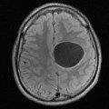 creier tratament hidrocefalie, simptome si cauze (simptome) creier hidrocefalie tratament, simptome si cauze