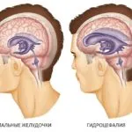 Hidrocefalie semne sindrom hipertensivă și tratamentul bolii smptomy (hipertensivi) Hidrocefalie semne sindrom hipertensivă și tratamentul bolii smptomy