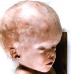 Hidrocefalie semne sindrom hipertensivă și tratamentul bolii smptomy (sindrom) Hidrocefalie semne sindrom hipertensivă și tratamentul bolii smptomy