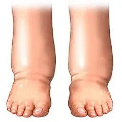 Hiperhidratarea a corpului - simptome, tratament