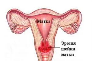 Ginecologică operațiune tipuri și metode de recuperare