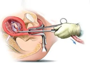 Ginecologică operațiune tipuri și metode de recuperare