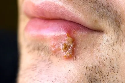 Herpes pe buze - cauze, semne, simptome, tratament (motive) Herpes pe buze - cauze, semne, simptome, tratament
