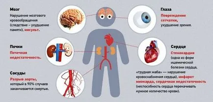 Cauzele hipertensive boli de inima, simptome, tratamentul hipertensiunii arteriale