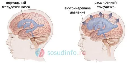 sindromul hipertensiv, copii și adulți hidrocefalie