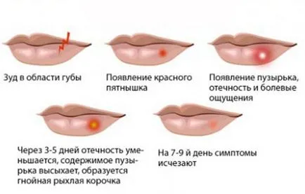 Herpes pe buze - cauze, semne, simptome, tratament (semne) Herpes pe buze - cauze, semne, simptome, tratament