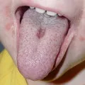 Glossalgia - tratament, fotografie, simptome, cum de a trata glossalgia (glossalgia) Glossalgia - tratament, fotografie, simptome, cum de a trata glossalgia