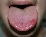 Glossalgia - cauze, simptome, diagnostic și tratament