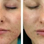 Glicolic Exfoliere (acid) cum se face la domiciliu, contraindicații (fotografii înainte și după)