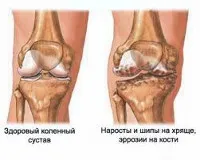 Osteoartrita - cauze, simptome, diagnostic și tratament