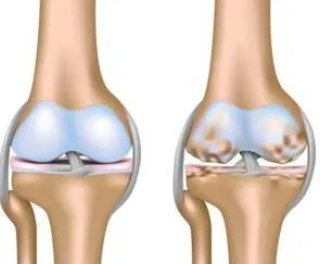 Osteoartrita - Ce este gonartroz 2, gradul 3 de tratament