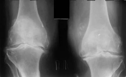 Osteoartrita a genunchiului, ceea ce este și tipurile sale, simptome si tratamente