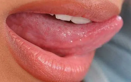 Glossalgia simptome, cauze si tratamente glossalgia limba