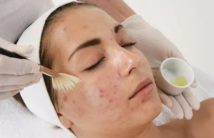 Coji de glycolic faciale la domiciliu, cum se face procedura