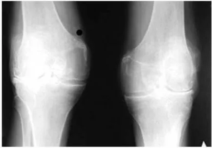 Osteoartrita a genunchiului, ceea ce este și tipurile sale, simptome si tratamente