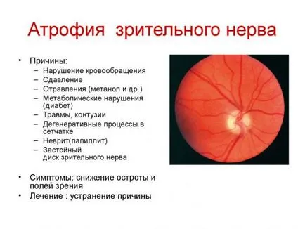 Glaucomul - cum este de a trata, dacă congenitale, diagnosticare, picături pentru ochi cauza (glaucom) Glaucomul - ceea ce este de a trata, fie congenitală, diagnostic, cauze, picături pentru ochi,
