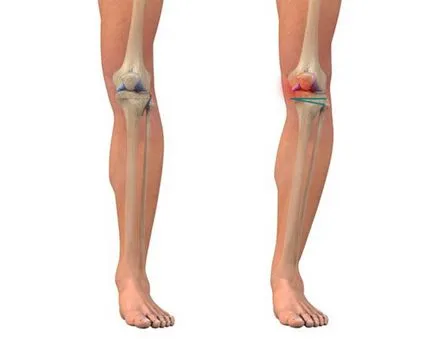 Osteoartrita - Ce este gonartroz 2, gradul 3 de tratament