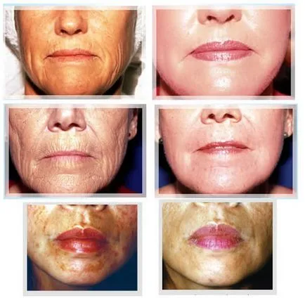 Coji de faciale glycolic - comentarii