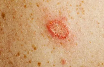 Simptome si tratament Ciuperci de piele
