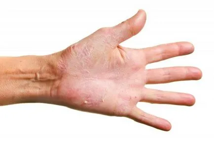Simptome si tratament Ciuperci de piele