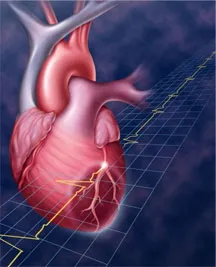 infarctul miocardic și formele sale