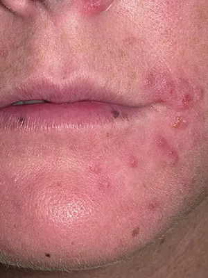 Boli infecțioase ale cauzelor pielii și a părului, simptome de infecții fungice ale pielii și