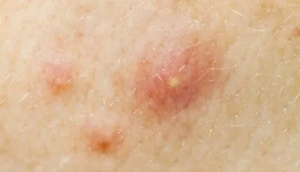 boli infecțioase ale pielii - tratament fotografie