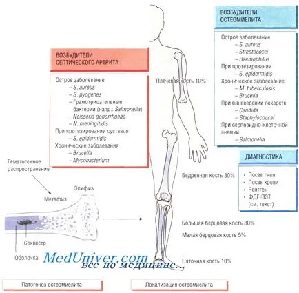Boli infecțioase ale oaselor și articulațiilor - osteomielita si artrita cauze, diagnostic, tratament (articulații) Boli infecțioase ale oaselor și articulațiilor - osteomielita si artrita cauze, diagnostic, tratament