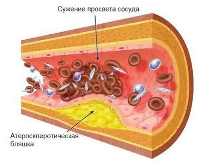 Ischemia cauze, tratamente, efecte, masura si simptome