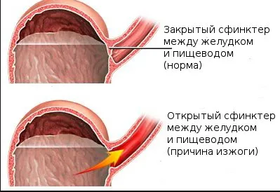 Arsuri la stomac cauze, consecințe, și a scăpa de arsuri la stomac la domiciliu