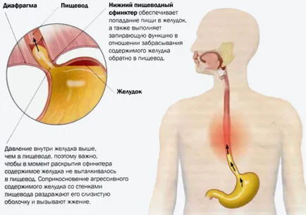 Arsuri la stomac cauze, consecințe, și a scăpa de arsuri la stomac la domiciliu