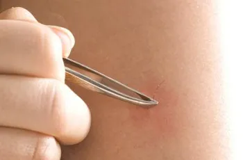 Cum să scapi de fire de par incarnate, metode, mijloace, prevenirea ingrijire corporala