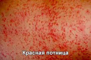 Cum de a vindeca copilul înțepător de căldură (foto) (înțepător de căldură) Cum de a vindeca copilul de căldură înțepător (poze)