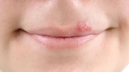 Cum de a distinge herpes de la un cos pe buza de fotografii, simptome herpes