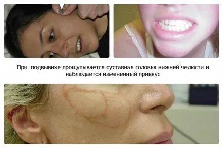 Care sunt simptomele de dislocare a maxilarului, și modul în care tratamentul maxilarului, în video - repoziționați maxilarului