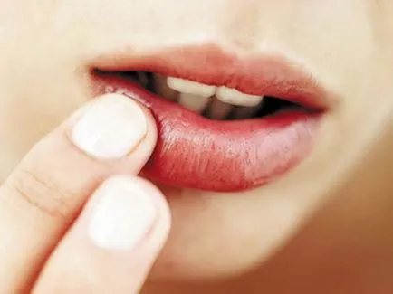 Cum de a distinge herpes de la un cos pe buza de fotografii, simptome herpes