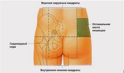 Cum de a face în mod corespunzător și în condiții de siguranță injecții în fese (dreapta) Cum de a face în mod corespunzător și în condiții de siguranță injecții în fese