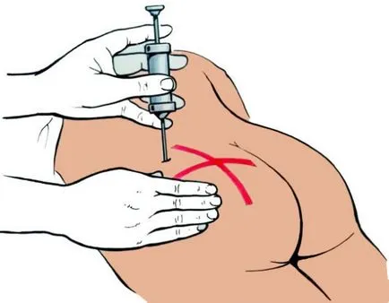 Cum de a face în mod corespunzător și în condiții de siguranță injecții în fese (dreapta) Cum de a face în mod corespunzător și în condiții de siguranță injecții în fese