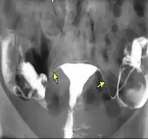 Cum de a verifica trompelor uterine articol Natalia Saraievo on-line (sarcina) Cum de a verifica trompelor uterine articol Natalia Saraievo on-line