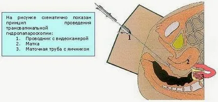 Cum de a verifica trompelor uterine articol Natalia Saraievo on-line (de evaluare a condițiilor uterine) Cum de a verifica trompelor uterine articol Natalia Saraievo on-line