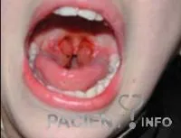 Cum de a face un gât roșu la medic (în roșu) Cum de a face un gât roșu la medic
