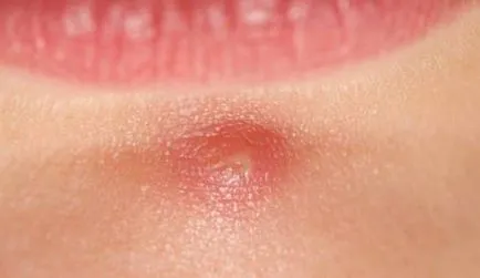 Cum de a scuti de inflamație de acnee, decât să-l elimine pe fața lui rapid (inflamație) Cum de a scuti de inflamație de acnee, decât repede eliminați-l pe față