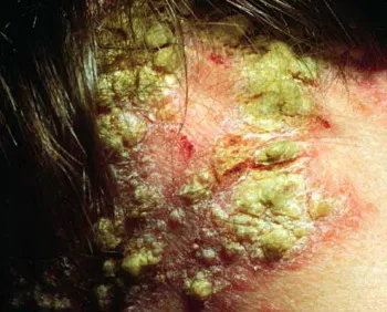 Tratamentul psoriazisului pe cap - 26 rețete! (Tratament) Tratamentul psoriazisului pe cap - 26 rețete!
