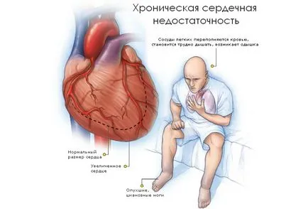 Tratamentul de dispnee în insuficiența cardiacă îndepărtarea simptom și ce medicamente pentru a lua (eliminarea dispnee în insuficiența cardiacă) Tratamentul de dispnee în insuficiența cardiacă îndepărtarea simptom și ce medicamente pentru a lua