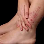 Cum elimin o vânătaie pe picior cu ajutorul acasă căi de atac