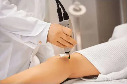 Cum de a elimina vene paianjen - se luptă cu plasă vasculară