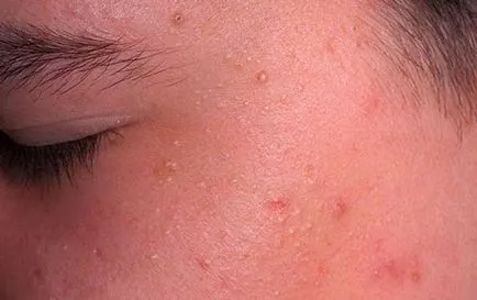 Cum de a reduce acnee - rapid, roșeață, pe noapte, inflamație, facială