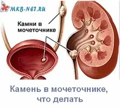 O piatră în ureter ce să facă sau 4 moduri de a scăpa de flagelul (piatra) O piatră în ureter ce să facă sau 4 moduri de a scăpa de flagelul