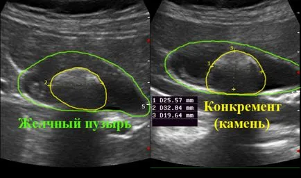 Pietrele din ficat simptomele, cum de a dispune și de tratament (ficat) Calculi biliari în ficat simptomele, cum să scape și de tratament